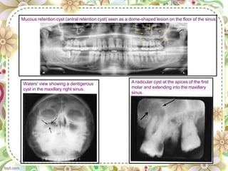 A radicular cyst at the apices of the first
molar and extending into the maxillary
sinus.
Waters' view showing a dentigerous
cyst in the maxillary right sinus.
Mucous retention cyst (antral retention cyst) seen as a dome-shaped lesion on the floor of the sinus.
 