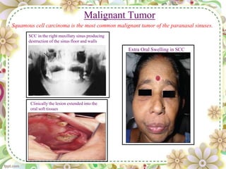 Malignant Tumor
SCC in the right maxillary sinus producing
destruction of the sinus floor and walls
Clinically the lesion extended into the
oral soft tissues
Squamous cell carcinoma is the most common malignant tumor of the paranasal sinuses.
Extra Oral Swelling in SCC
 