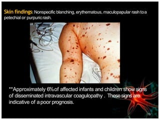 Skin findings: Nonspecific blanching, erythematous, maculopapular rash toa
petechial or purpuricrash.
**Approximately 6%of affected infants and children show signs
of disseminated intravascular coagulopathy . Thesesignsare
indicative of apoor prognosis.
19
 