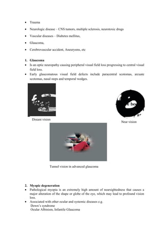 • Trauma
• Neurologic disease – CNS tumors, multiple sclerosis, neurotoxic drugs
• Vascular diseases – Diabetes mellitus,
• Glaucoma,
• Cerebrovascular accident, Aneurysms, etc
1. Glaucoma
• Is an optic neuropathy causing peripheral visual field loss progressing to central visual
field loss.
• Early glaucomatous visual field defects include paracentral scotomas, arcuate
scotomas, nasal steps and temporal wedges.
Tunnel vision in advanced glaucoma
2. Myopic degeneration
• Pathological myopia is an extremely high amount of nearsightedness that causes a
major alteration of the shape or globe of the eye, which may lead to profound vision
loss.
• Associated with other ocular and systemic diseases e.g.
Down’s syndrome
Ocular Albinism, Infantile Glaucoma
Distant vision
Near vision
 
