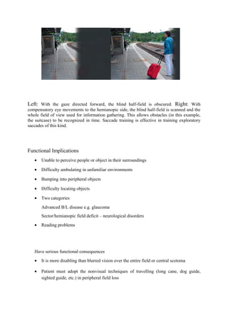 Left: With the gaze directed forward, the blind half-field is obscured. Right: With
compensatory eye movements to the hemianopic side, the blind half-field is scanned and the
whole field of view used for information gathering. This allows obstacles (in this example,
the suitcase) to be recognized in time. Saccade training is effective in training exploratory
saccades of this kind.
Functional Implications
• Unable to perceive people or object in their surroundings
• Difficulty ambulating in unfamiliar environments
• Bumping into peripheral objects
• Difficulty locating objects
• Two categories
Advanced B/L disease e.g. glaucoma
Sector/hemianopic field deficit – neurological disorders
• Reading problems
Have serious functional consequences
• It is more disabling than blurred vision over the entire field or central scotoma
• Patient must adopt the nonvisual techniques of travelling (long cane, dog guide,
sighted guide, etc.) in peripheral field loss
 