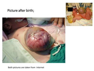 Picture after birth;
Both pictures are taken from internet
 
