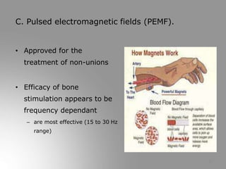 22
C. Pulsed electromagnetic fields (PEMF).
• Approved for the
treatment of non-unions
• Efficacy of bone
stimulation appears to be
frequency dependant
– are most effective (15 to 30 Hz
range)
 