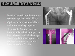 Intertrochanteric hip fractures are
common injuries in the elderly.
Options include extramedullary
and intramedullary implants.
In unstable fracture patterns,
intramedullary devices appear to
have a biomechanical advantage
,lowering the forces imposed on
the implant due to the shorter
lever arm of the fixation.
RECENT ADVANCES
 