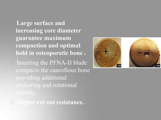 Large surface and
increasing core diameter
guarantee maximum
compaction and optimal
hold in osteoporotic bone .
Inserting the PFNA-II blade
compacts the cancellous bone
providing additional
anchoring and rotational
stability.
Higher cut outresistance.
 