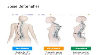 Spine Deformities
 