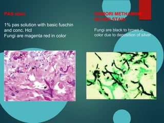 GOMORI METHAMINE
SILVER STAIN
Fungi are black to brown in
color due to deposition of silver
PAS stain
1% pas solution with basic fuschin
and conc. Hcl
Fungi are magenta red in color
 