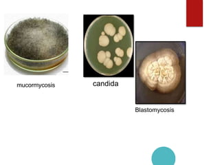 Mucormycosis
candida
Blastomycosis
mucormycosis
 