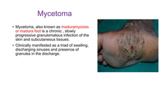 Mycetoma
• Mycetoma, also known as maduramycosis
or madura foot is a chronic , slowly
progressive granulomatous infection of the
skin and subcutaneous tissues.
• Clinically manifested as a triad of swelling,
discharging sinuses and presence of
granules in the discharge.
 