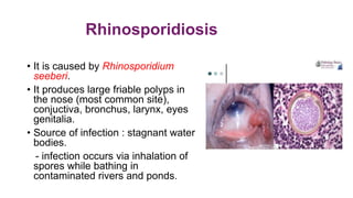 Rhinosporidiosis
• It is caused by Rhinosporidium
seeberi.
• It produces large friable polyps in
the nose (most common site),
conjuctiva, bronchus, larynx, eyes
genitalia.
• Source of infection : stagnant water
bodies.
- infection occurs via inhalation of
spores while bathing in
contaminated rivers and ponds.
 
