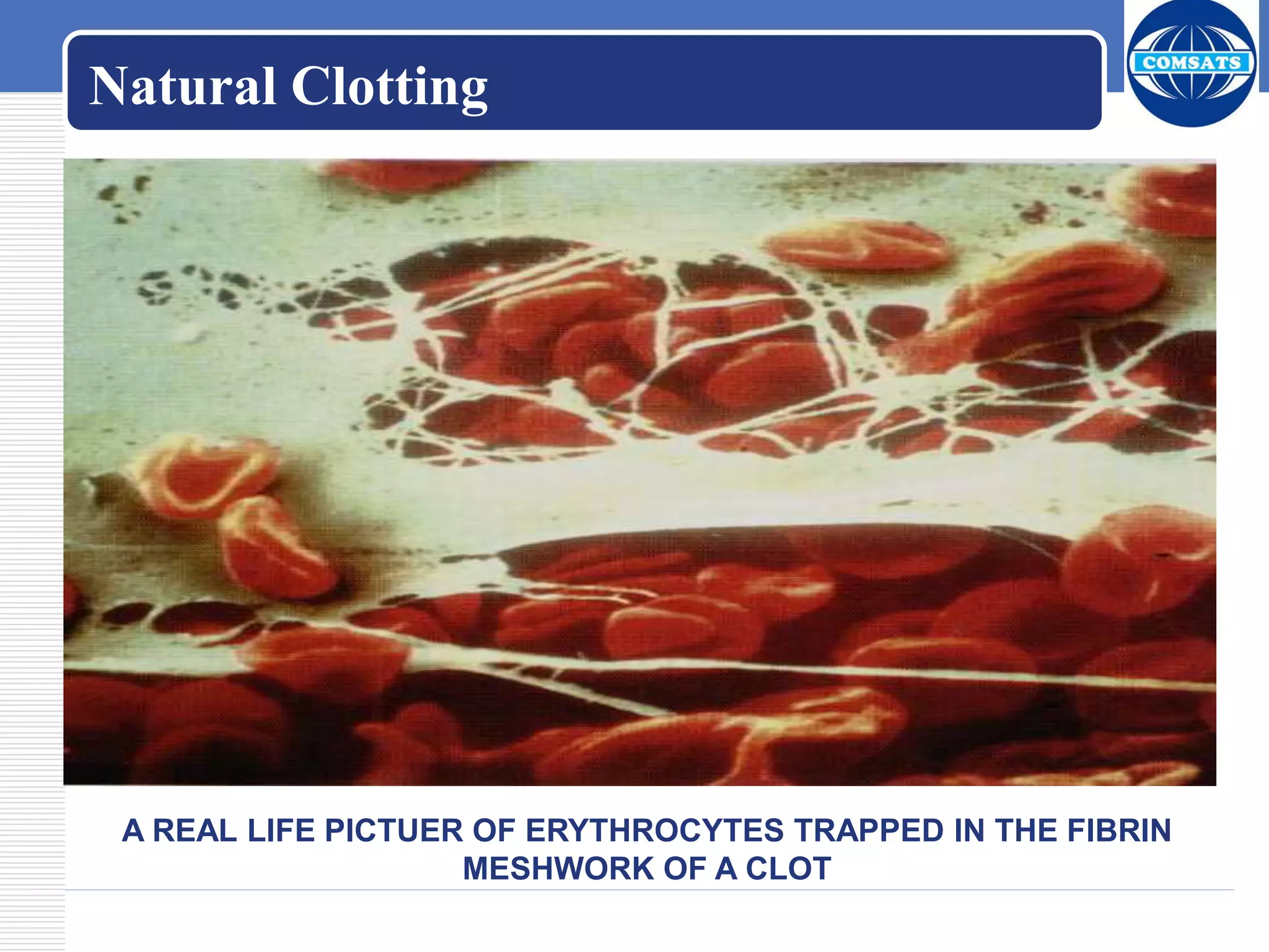 A REAL LIFE PICTUER OF ERYTHROCYTES TRAPPED IN THE FIBRIN
MESHWORK OF A CLOT
Natural Clotting
 