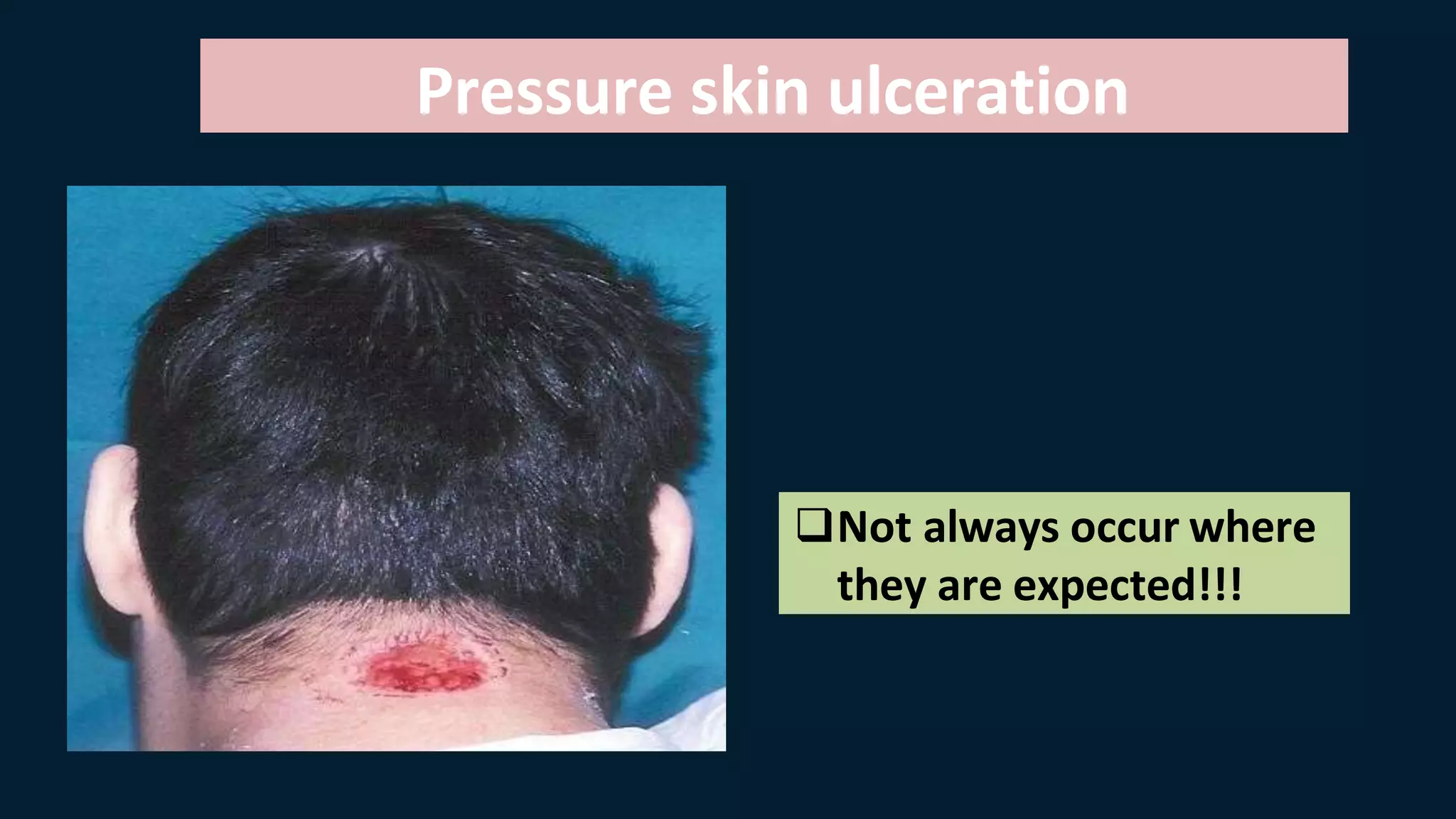 Not always occur where
they are expected!!!
Pressure skin ulceration
 