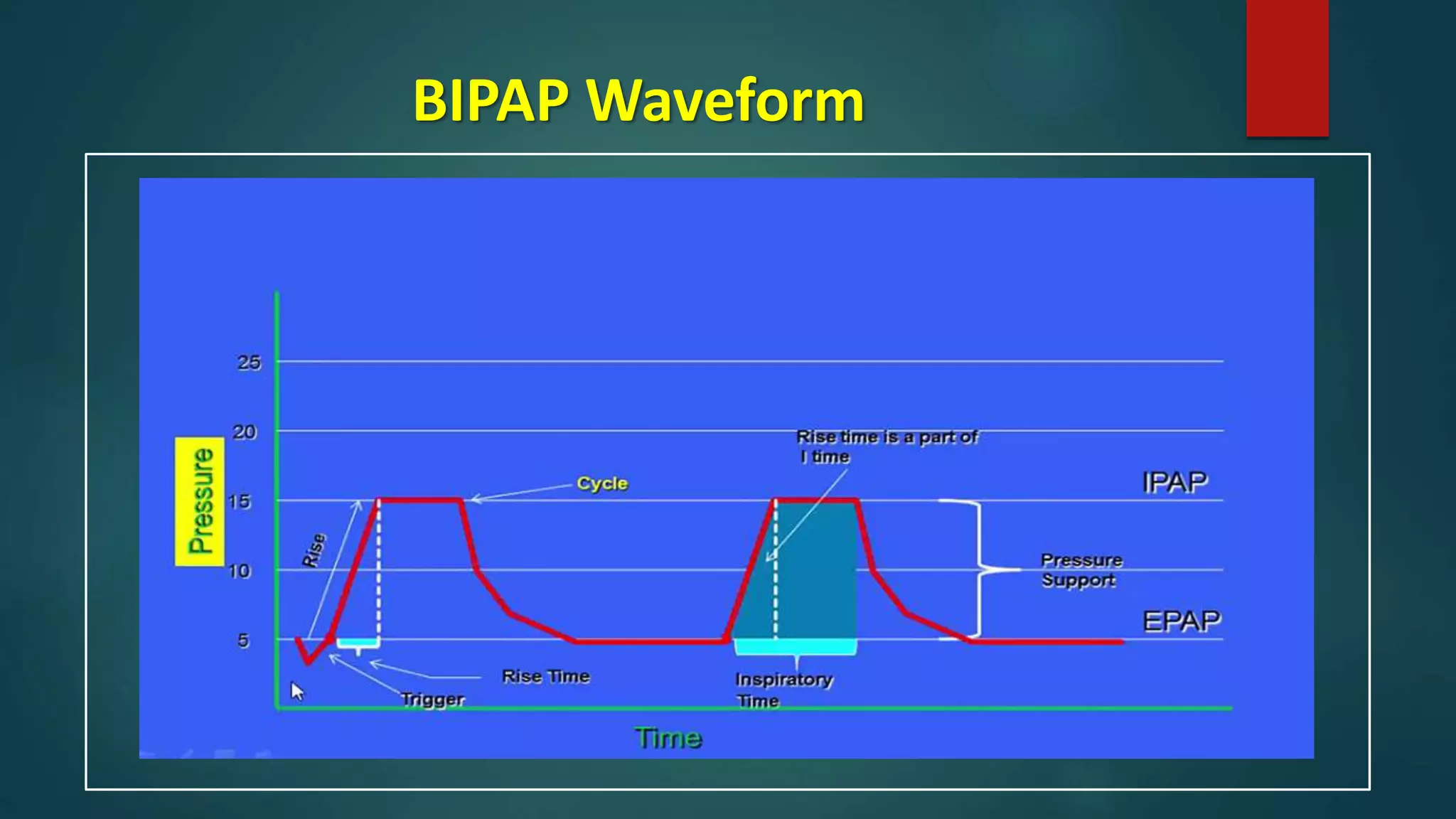 BIPAP Waveform
 