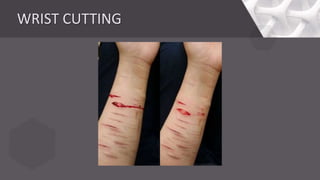 SELF HARMING BEHAVIOR | PPT