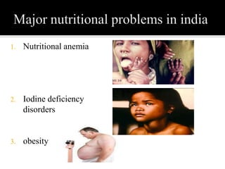 1. Nutritional anemia
2. Iodine deficiency
disorders
3. obesity
 