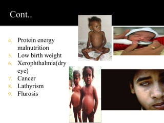 4. Protein energy
malnutrition
5. Low birth weight
6. Xerophthalmia(dry
eye)
7. Cancer
8. Lathyrism
9. Flurosis
 