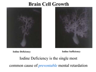 Brain Cell Growth
Iodine Deficiency Iodine Sufficiency
Iodine Deficiency is the single most
common cause of preventable mental retardation
 
