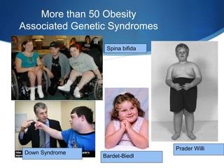 More than 50 Obesity
Associated Genetic Syndromes
Bardet-Biedl
Prader Willi
Spina bifida
Down Syndrome
 