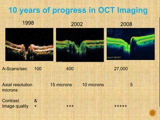 1998 20082002
A-Scans/sec 100 400 27,000
Axial resolution 15 microns 10 microns 5
microns
Contrast &
Image quality + +++ +++++
10 years of progress in OCT Imaging
 