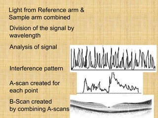 Light from Reference arm &
Sample arm combined
Division of the signal by
wavelength
Analysis of signal
Interference pattern
A-scan created for
each point
B-Scan created
by combining A-scans
 