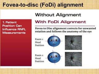 Fovea-to-disc (FoDi) alignment
 