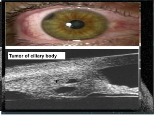 HD-OCT scan of normal cornea. Layers identified with colored arrows as follows:
tear film (blue), epithelium (white), Bowman’s layer (red), Descemet’s/endothelium
(green).
Conical cornea with central stromal
thinning
Tumor of the iris
Obscuring the angleTumor of ciliary body
 