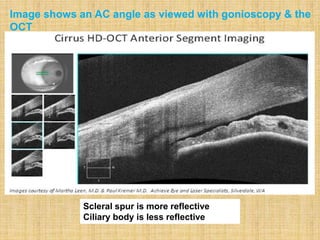 A study comparing AS-OCT with Goniscopy
 AS-OCT detected more closed angles than gonioscopy
Disparity to attributed
 Possible distortion of the anterior segment by contact
gonioscopy
 Differences in illumination
Image shows an AC angle as viewed with gonioscopy & the
OCT
Scleral spur is more reflective
Ciliary body is less reflective
 