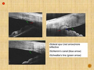•Scleral spur (red arrow)more
reflective
•Schlemm’s canal (blue arrow)
•Schwalbe’s line (green arrow)
 