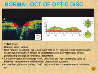 NORMAL OCT OF OPTIC DISC
• TSNIT graph
• Double Hump PAttern
• OCT helps in detecting RNFL loss even with no VF defects in disc suspects and
ocular hypertensives(in stages of undetectable and asymptomatic) before
progressing to stage of functional impairment
• Clinically inferior and average RNFL thickness are most commonly used as
baseline measurement and follow up of glaucoma suspects
• In manifest glaucoma patient, RNFL region with least measurements is followed
up
 
