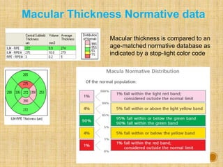 Macular thickness is compared to an
age-matched normative database as
indicated by a stop-light color code
Macular Thickness Normative data
 