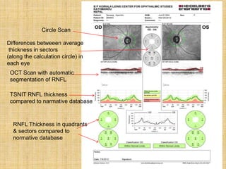Circle Scan
Differences betweeen average
thickness in sectors
(along the calculation circle) in
each eye
OCT Scan with automatic
segmentation of RNFL
TSNIT RNFL thickness
compared to narmative database
RNFL Thickness in quadrants
& sectors compared to
normative database
 