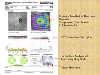 Posterior Pole Retinal Thickness
Map with
Compressed Color Scale in
8x8 Analysis Grid
Mean Thickness
Hemisphere Analysis with
Asymmetry Gray Scale
OCT scan of macular region
 