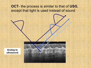 Analog to
ultrasound
OCT- the process is similar to that of USG,
except that light is used instead of sound
 