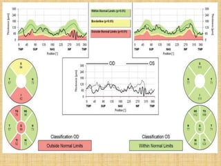 Case 2
A 55-year-old female diagnosed with
primary open angle glaucoma OD
 