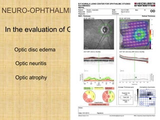 NEURO-OPHTHALMIC
In the evaluation of ONH
Optic disc edema
Optic neuritis
Optic atrophy
 