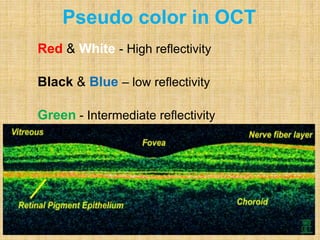 Red & White - High reflectivity
Black & Blue – low reflectivity
Green - Intermediate reflectivity
Pseudo color in OCT
 