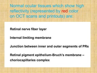 Retinal nerve fiber layer
Internal limiting membrane
Junction between inner and outer segments of PRs
Retinal pigment epithelium-Bruch’s membrane –
choriocapillaries complex
Normal ocular tissues which show high
reflectivity (represented by red color
on OCT scans and printouts) are:
 