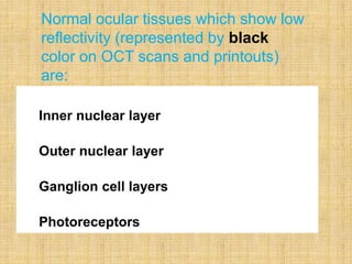 Inner nuclear layer
Outer nuclear layer
Ganglion cell layers
Photoreceptors
Normal ocular tissues which show low
reflectivity (represented by black
color on OCT scans and printouts)
are:
 