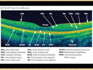 Inner plexiform layers
Outer plexiform layers
External limiting membrane
Normal ocular tissues which show
intermediate reflectivity
(represented by Green color on OCT
scans and printouts) are:
 
