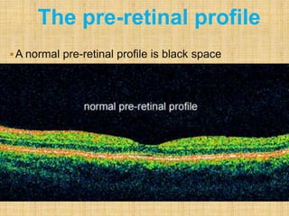 A normal pre-retinal profile is black space
Because the normal vitreous space is translucent,
meaning it has minimal reflective properties
The small, faint, bluish dots in the pre-retinal space
is "noise“
This is an electronic aberration created by increasing
the sensitivity of the instrument to better visualize
low reflective structures
The pre-retinal profile
 