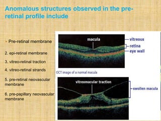  Pre-retinal membrane
A pre-retinal membrane with traction on the fovea
2. epi-retinal membrane
3. vitreo-retinal traction
4. vitreo-retinal strands
5. pre-retinal neovascular
membrane
6. pre-papillary neovascular
membrane
Anomalous structures observed in the pre-
retinal profile include
 