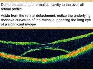 Demonstrates an abnormal convexity in the over-all
retinal profile.
In this case, a pigment epithelial detachment is causing
the convexity.
Demonstrates an abnormal concavity to the over-all
retinal profile
Aside from the retinal detachment, notice the underlying
concave curvature of the retina, suggesting the long eye
of a significant myope
 