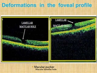  Macular pucker
Macular lamellar hole
Deformations in the foveal profile
 