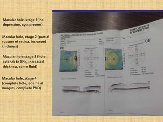 Macular hole, stage 4
(complete hole, edema at
margins, complete PVD)
Macular hole, stage 1( no
depression, cyst present)
Macular hole, stage 2 (partial
rupture of retina, incraesed
thickness)
Macular hole stage 3 (hole
extends to RPE, increased
thickness, some fluid)
 