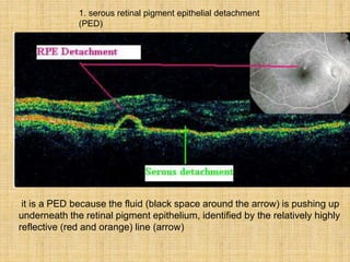 it is a PED because the fluid (black space around the arrow) is pushing up
underneath the retinal pigment epithelium, identified by the relatively highly
reflective (red and orange) line (arrow)
1. serous retinal pigment epithelial detachment
(PED)
 