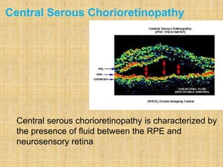 Central Serous Chorioretinopathy
Central serous chorioretinopathy is characterized by
the presence of fluid between the RPE and
neurosensory retina
 