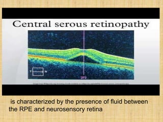 is characterized by the presence of fluid between
the RPE and neurosensory retina
 