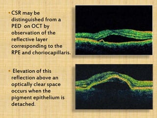 CSR may be
distinguished from a
PED on OCT by
observation of the
reflective layer
corresponding to the
RPE and choriocapillaris.
 Elevation of this
reflection above an
optically clear space
occurs when the
pigment epithelium is
detached.
 