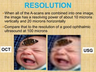 RESOLUTION
When all of the A-scans are combined into one image,
the image has a resolving power of about 10 microns
vertically and 20 microns horizontally
Compare that to the resolution of a good ophthalmic
ultrasound at 100 microns
OCT USG
 