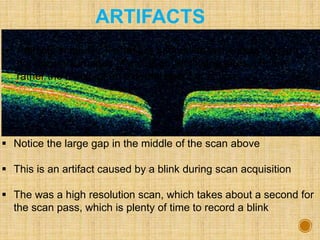 ARTIFACTS
 Notice the large gap in the middle of the scan above
 This is an artifact caused by a blink during scan acquisition
 The was a high resolution scan, which takes about a second for
the scan pass, which is plenty of time to record a blink
 Artifacts in the OCT scan are anomalies in the scan that are
not accurate images of actual physical structures, but are
rather the result of an external agent or action
 